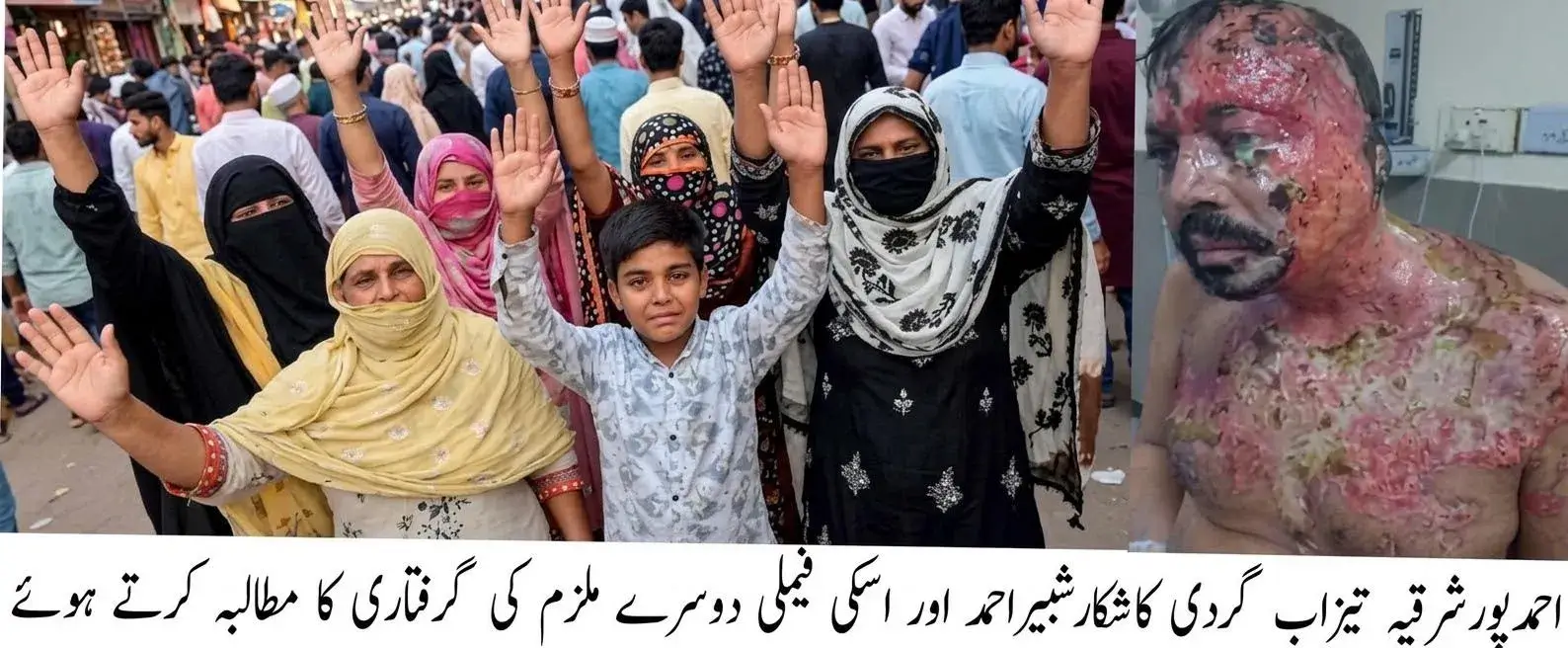 In Ahmadpur East, wife along with her lover throws acid on husband Shabbir Ahmed, burning him